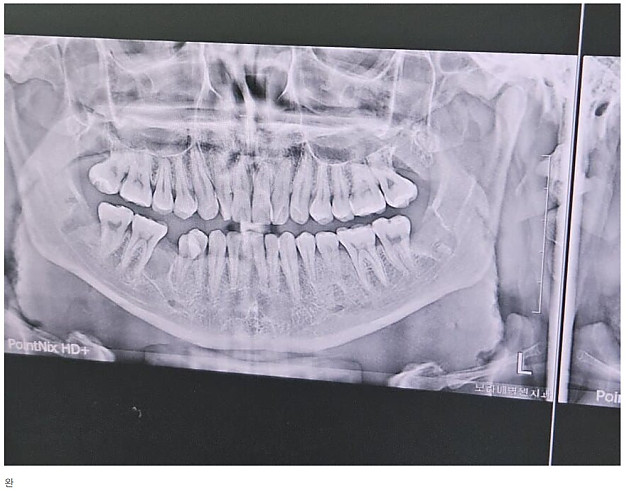 어느 사랑니갤러리의 사랑니