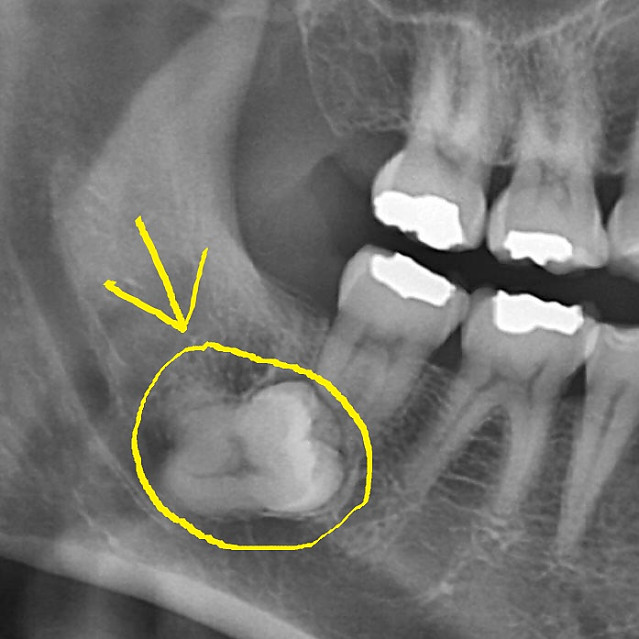 치과의사도 기도하게 만드는 X-레이 짤
